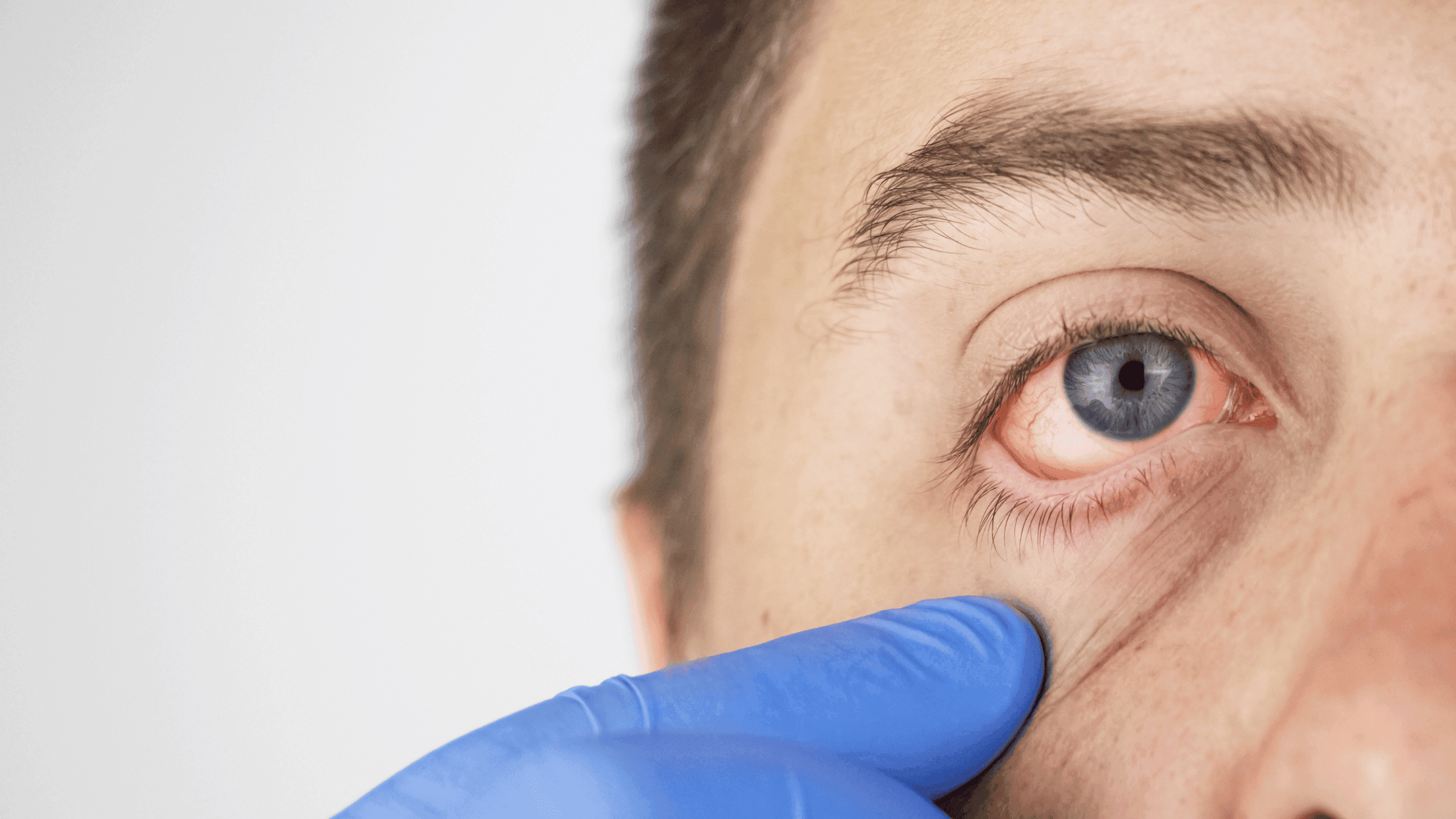 Alergijski konjunktivitis: zašto vas peku i suze oči i što pomaže